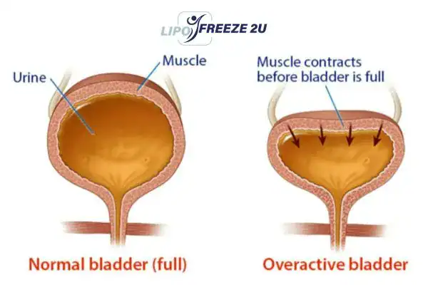 diagram of overactive bladder treatment Richmond
