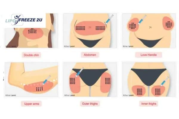 Benefits of Choosing Aqualyx for Fat Reduction Richmond