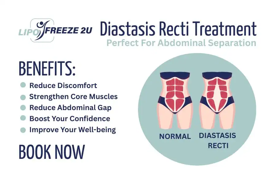 Benefits of body toning treatment Richmond for Diastasis recti