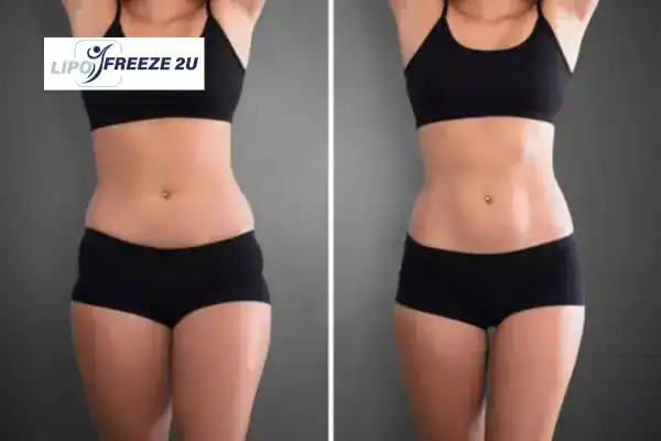 How Can LIPO FREEZE 2U Support Your Post-Pregnancy Body Recovery Richmond?