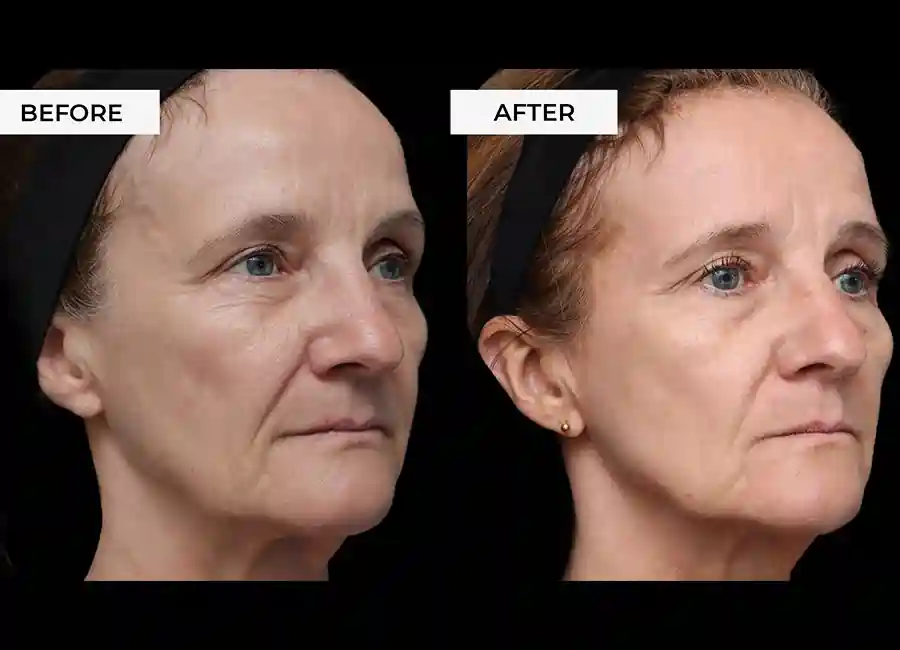 How Many RF Microneedling Sessions Will You Need to See a Difference Richmond?