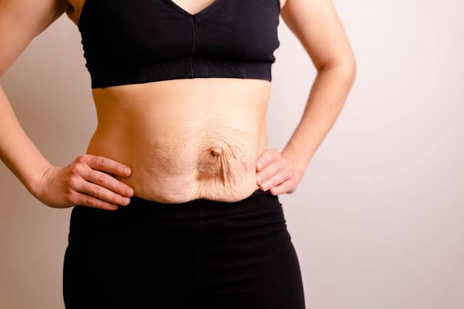 Is Surgery Really the Only Way to Repair Diastasis Recti Richmond?