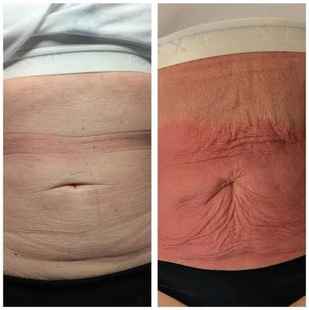 How Does RF Microneedling Improve Crepey, Thin and Uneven Skin Texture Richmond?